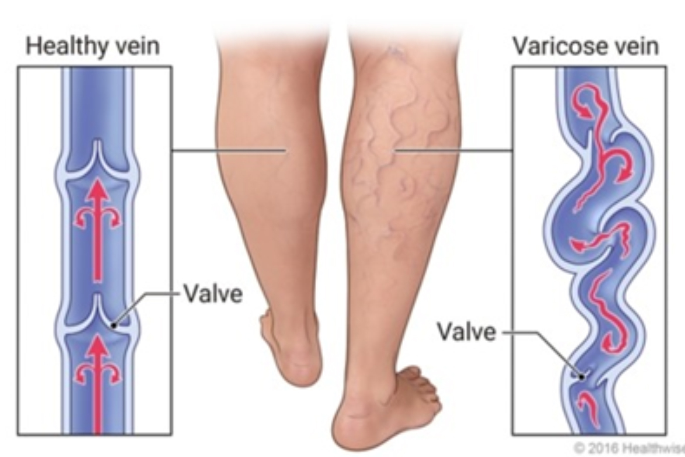 General Information about Varicose Veins and Their Treatmentss
