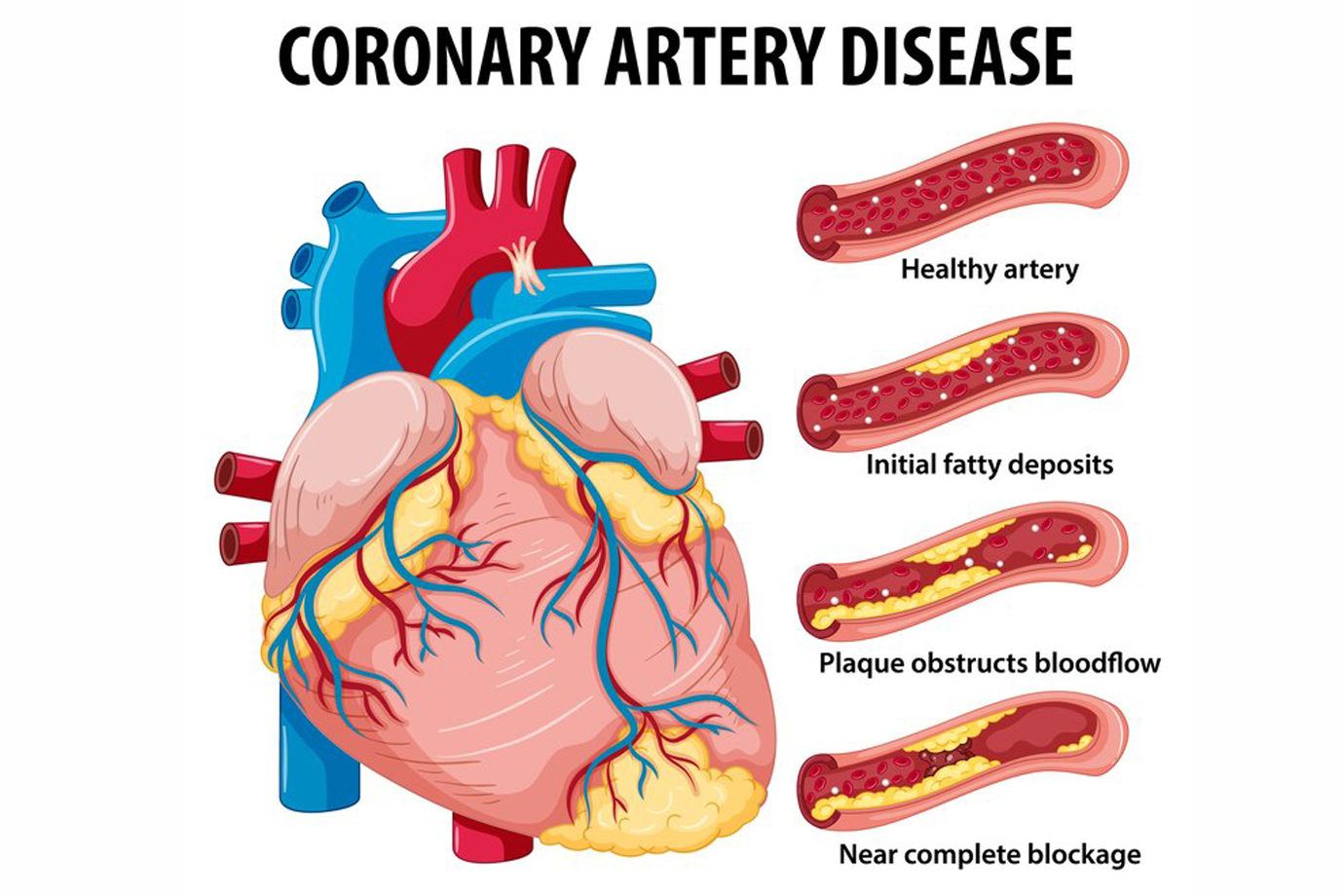 Understanding Coronary Artery Bypass Grafting (CABG)