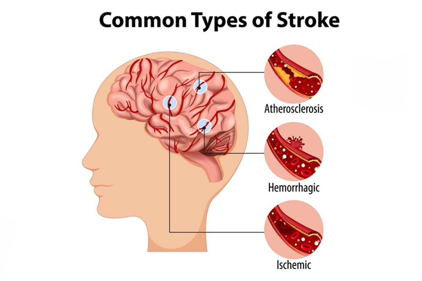 Understanding Stroke: Symptoms, Causes, and Prevention 