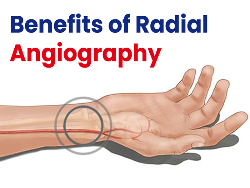 benefits-of-radial-angiography
