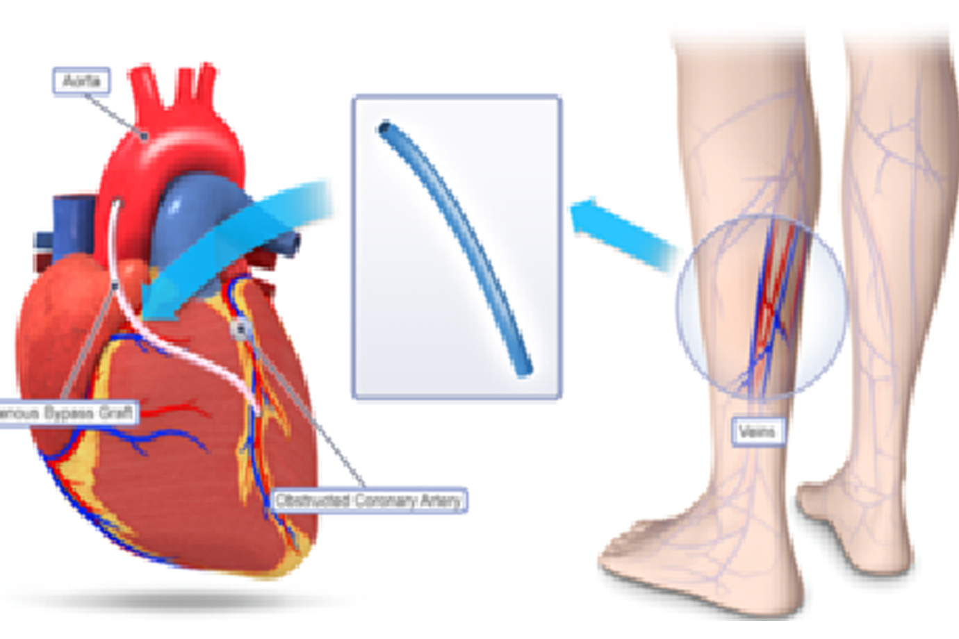 Compression Stockings