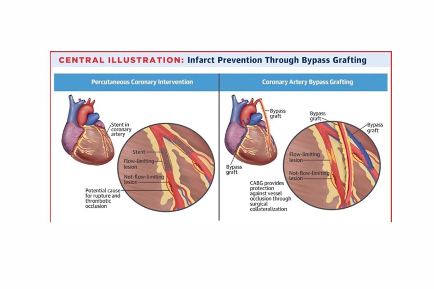 CABG versus Other Cardiac Interventions: Making the Right Choice