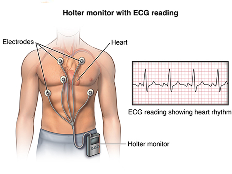 general-information-about-holter-monitors