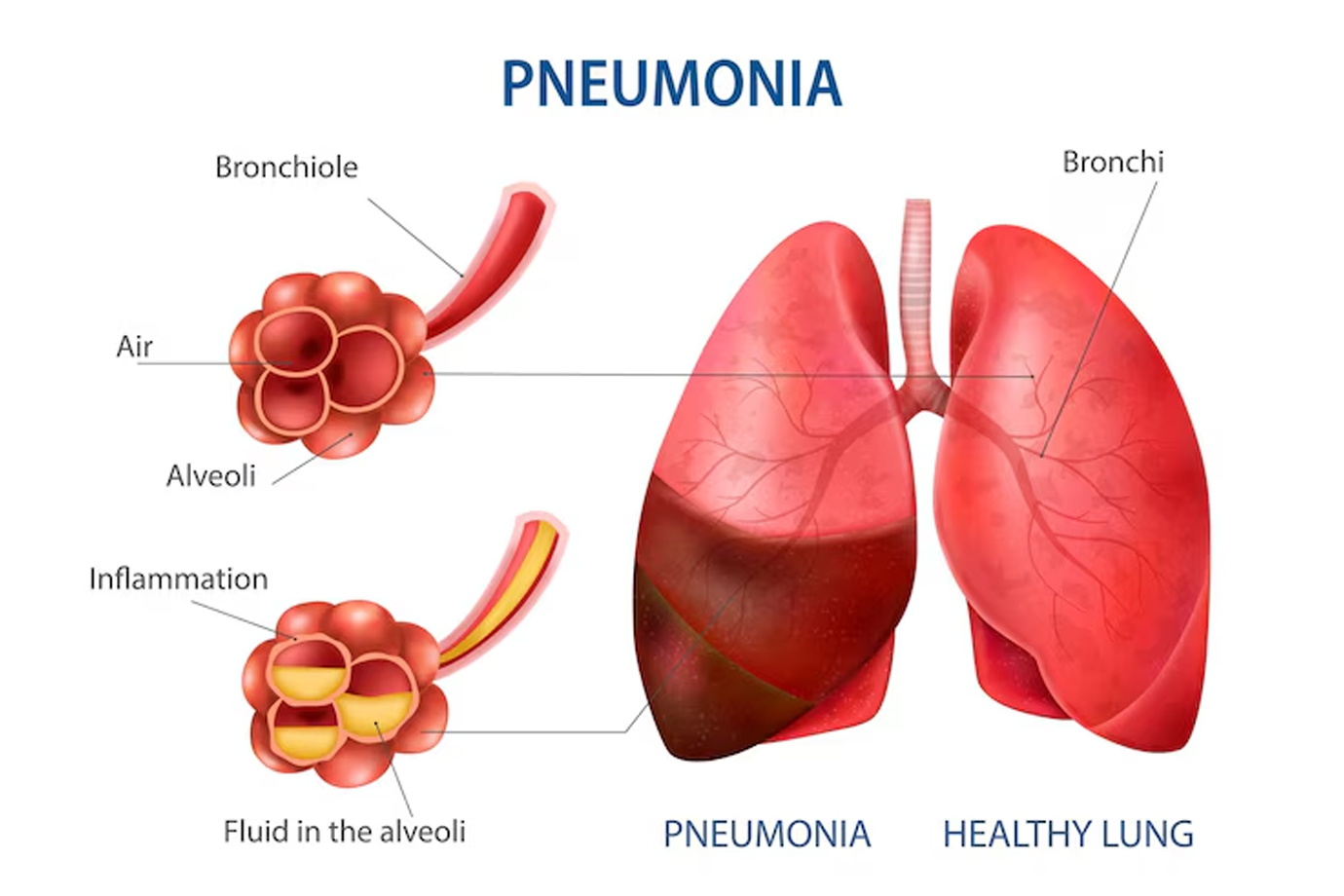 Introduction to Pneumonia 